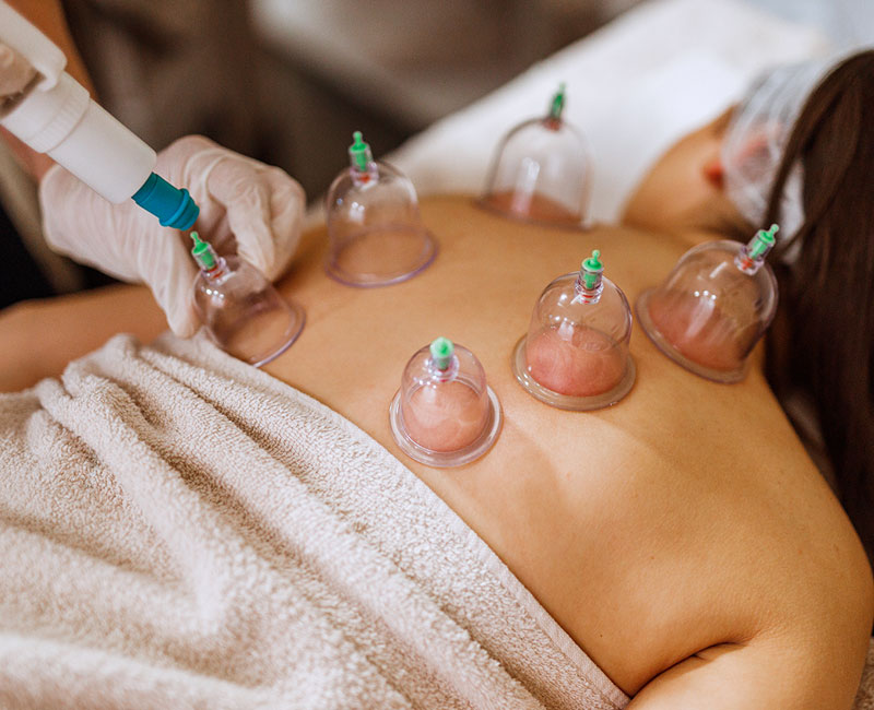Hijama / Cupping Therapy