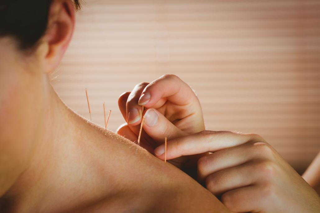 Acupuncture Treatment gallery image